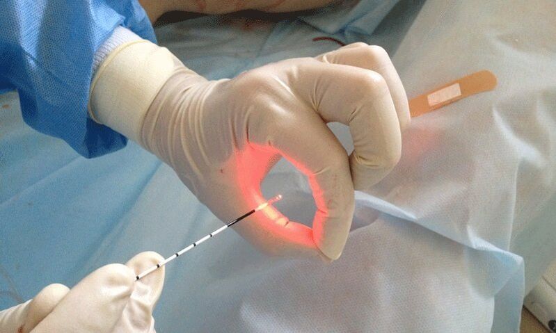 Tratamento con láser para a prostatite